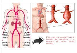 Cuanto mayor sea el aneurisma. Aneurisma Aorta Abdominal Aneurismas Com Mx