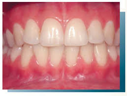 Image result for Gingiva