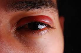 Auge Geschwollen Das Hilft
