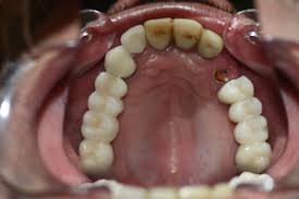 Hay Que Poner Una Funda O Corona Despues De Endodonciar Una Muela Velez Lozano