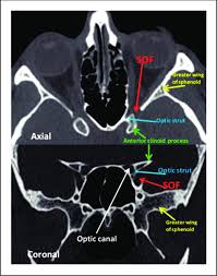 The muscles of the back are separated into extrinsic and intrinsic components, which are based on their function in movement and embryological origin. Orbital Apex Anatomy Ct Axial And Coronal Ct Slices Demonstrate The Download Scientific Diagram