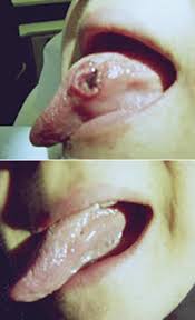 Image result for Puchýře na jazyku