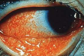 Conjunctivitis Kidshealth Nz
