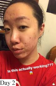 Dùng thử toner giấm táo trị mụn “thần thánh”, cô nàng này đã rút ra kết  luận đau thương