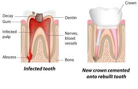 Plus, only a trained dentist can spot the. Root Canal Treatment Wichita Ks West Wichita Ks