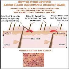 It mainly affects men with curly hair who shave too close and is most noticeable on the face and neck. The Real Cause Of Ingrown Hairs And How To Avoid Getting Them Ingrown Hair Irritated Skin Ingrown Hair Treatment