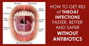 Now you're going to say, gosh, if i feel better in five days, i can stop my antibiotics. Home Remedies Are Always Effective And They Don T Have Any Side Effects Like Medicines Antibiotics Throat Infection Strep Throat Strep Throat Remedies