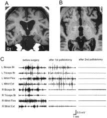 Image result for Pallidotomy