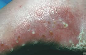 Of course, your specialist is the main person whose advice you should follow but it doesn't do anyone harm. Psoriasis Signs And Symptoms