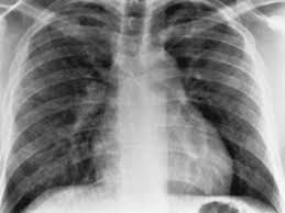 Acesta este cel mai frecvent tip de pneumonie bacteriana si apare atunci cand obtineti o. Pneumonia Pediatriavirtual Com