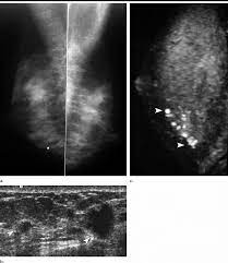 Images In 41 Year Old Woman With Multifocal Ilc And Multiple Foci Of Download Scientific Diagram