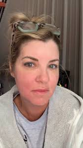 Swelling and redness is better and my face feels smoother this morning  after washing it. It’s still a little itchy but Benadryl helps a lot.  Really hoping that the swelling goes away today so I can go ...