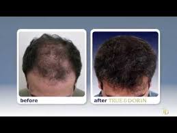 Here's a story about why you should, and why vitamin d can sometimes make the difference between hair loss and hair recovery. Medication That Causes Hair Loss Manhattan Nyc True Dorin Medical Group