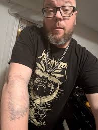 What is road rash and how to treat it?