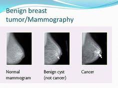 Breast cancer isn't what it was 20 years ago. Medfaw Medfaw14 Profile Pinterest