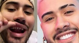 O cantor kevinho compartilhou com seus seguidores fotos de seu sorriso sem as lentes de contato que usa nos dentes. O Que Voce Precisa Saber Sobre Lente De Contato Dental Lifestyle R7 Beleza