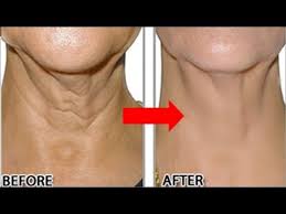Yoga Facial And Neck Exercises Firm Your Neck Using Face Yoga Youtube Neck Wrinkles Mouth Wrinkles Sagging Neck Skin