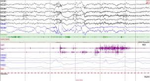 Image result for Polysomnogram