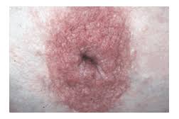 Because ibc grows quickly, it is usually found at a locally advanced stage, meaning that cancer cells have spread into nearby breast tissue or lymph nodes. Breast Cancer In Images