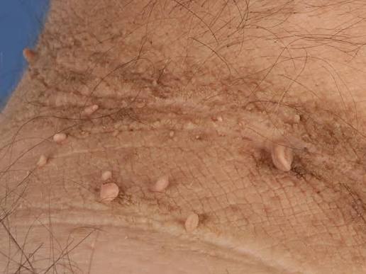 Fibroma