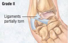 In this type of ankle sprain, there is usually some pain in the ankle or foot but the joint is not unstable. Ankle Sprain Guide Causes Symptoms And Treatment Options