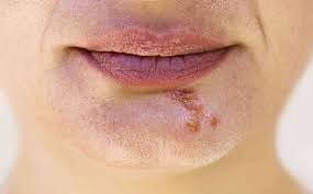 STI Pictures: Chlamydia, Genital Warts ...