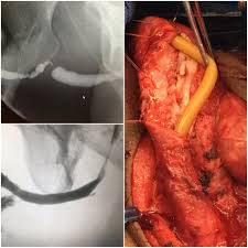 Image result for Urethral Stricture