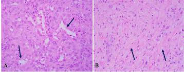 A volume in foundations in diagnostic pathology series (1st ed.). Adenomatoid Tumor In The Fallopian Tube A Rare Case