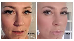 These acids are usually present in our body and at times the deficiency of these acids in the body may force in opting for. Juvederm Before And After With Dr Weinberg Mommy Gearest