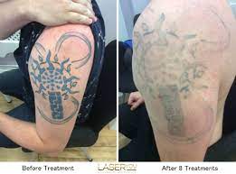 Redeem skin care clinic halifax, located in halifax, west yorkshire, united kingdom offers patients laser tattoo removal procedures among its total of 1 available procedures, across 1 different specialties. Tatto Wallpapers Tattoo Removal On Nhs