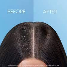 Dandruff is a common scalp condition in. How To Get Rid Of Dandruff From Hair Head Shoulders Au