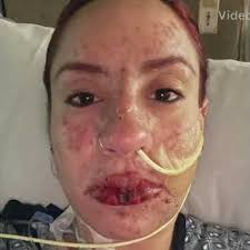 Fundraiser for Ada Marie Plaza Nieves by Robinson Camacho : Ada batallando  el Steven Johnson's Syndrome