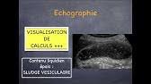 This brochure is intended to provide a general overview of a surgery. Cholecystite Chronique Calcul Vesicule Biliaire Symptomes Inflammation Et Cholecystectomie Youtube