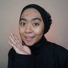 Acne Story Beauty Vlogger Vindy Berjerawat Karena Krim Abal Abal