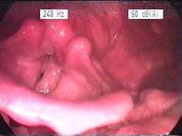 People are generally diagnosed at age 50 or older but it can develop at any age. Laryngitis Wikipedia