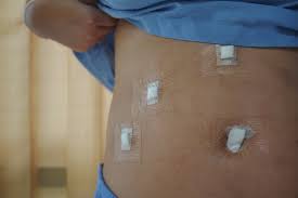 Also know, can dermabond stay on too long? Gallbladder Removal Surgery Cholecystectomy Patient Information From Sages