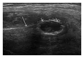 Aneurysmal bone cystti pathology reviewpt. Ultrasound Of Primary Aneurysmal Bone Cyst