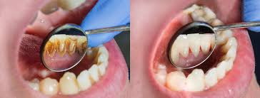 Tartar becomes yellowed, and aged looking as it continues to sit untouched. Removing Plaque From Teeth Plaque On Teeth Dental Plaque Removal