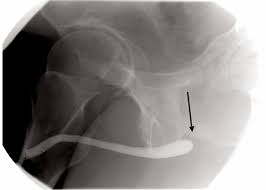 Image result for Retrograde Urethrogram