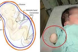 Apabila hal tersebut terjadi, segeralah ke dokter. Air Ketuban Sedikit Tangan Sang Bayi Terputus Dalam Rahim Ibunya