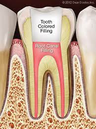 Root Canal Treatment Endodontist Norwalk Ct