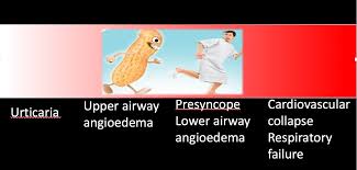 Anaphylaxis happens quickly after the exposure. Anaphylaxis Core Em