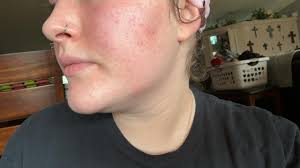 Hello!! I'm a nurse and struggle with rosacea (quite bad). My face is  constantly red and people make it worse when making comments like “are you  sunburnt or have you got a