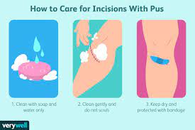 Pus: What It Is, What Causes It, And Treatments