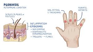 Image result for psoriasis