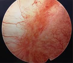 Image result for Interstitial Cystitis