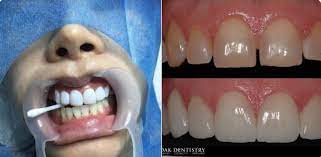 Klinik swasta biasa menawarkan harga yang tinggi berbanding dengan klinik kerajaan. Rawatan Putih Gigi