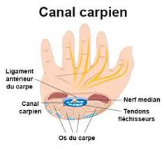 Douloureuse et parfois chronique, la tendinite est une inflammation généralement due au frottement du tendon contre l'os. Douleur De La Main Symptomes Traitement Definition Docteurclic Com