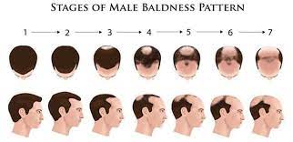 Acne medications containing vitamin a. How Can Male Pattern Baldness Be Common If It S Caused By Three Different Recessive Genes On Two Different Chromosomes Quora