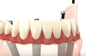 Partial Dental Dentures Vs Implants In Mexico Learn More About All On 4 Example Case Dental Dentures Mini Dental Implants Dental Bridge